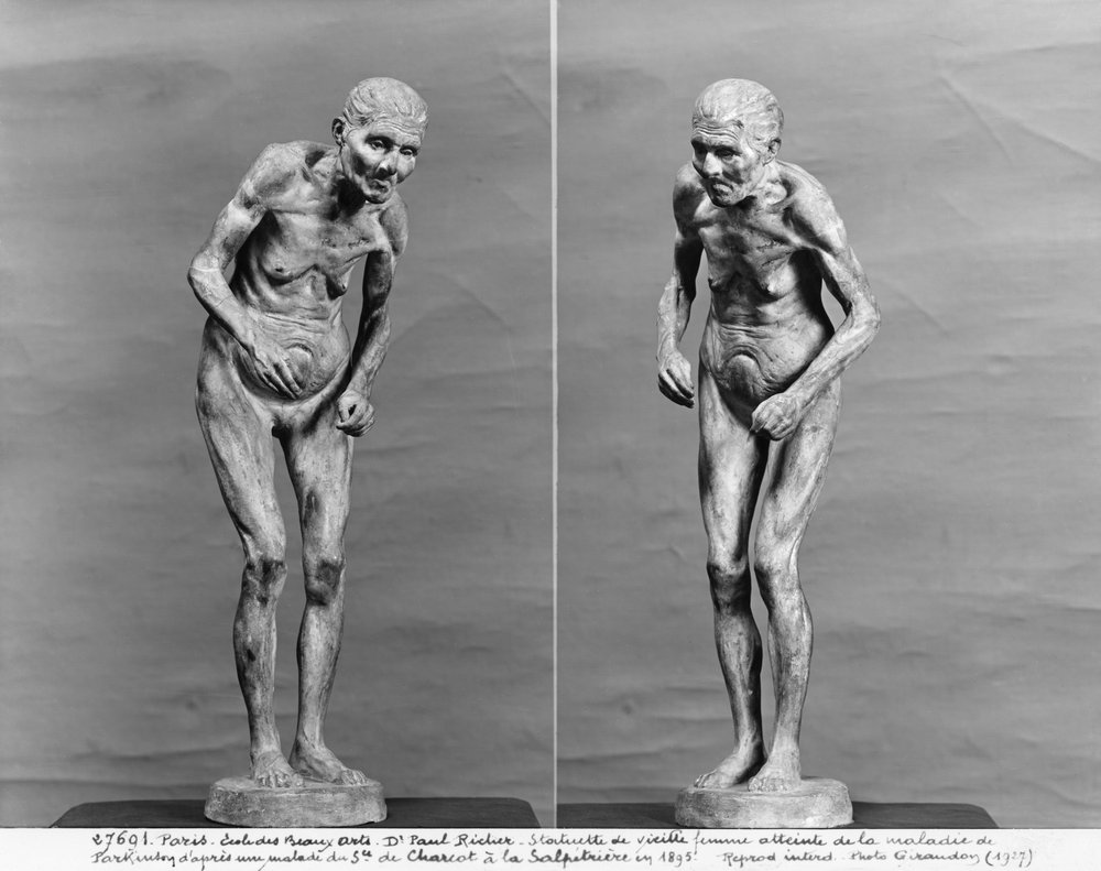 Parkinson-kórban szenvedő idős nő szobrocskája, 1895 után alkotó: Paul Marie Louis Pierre Richer