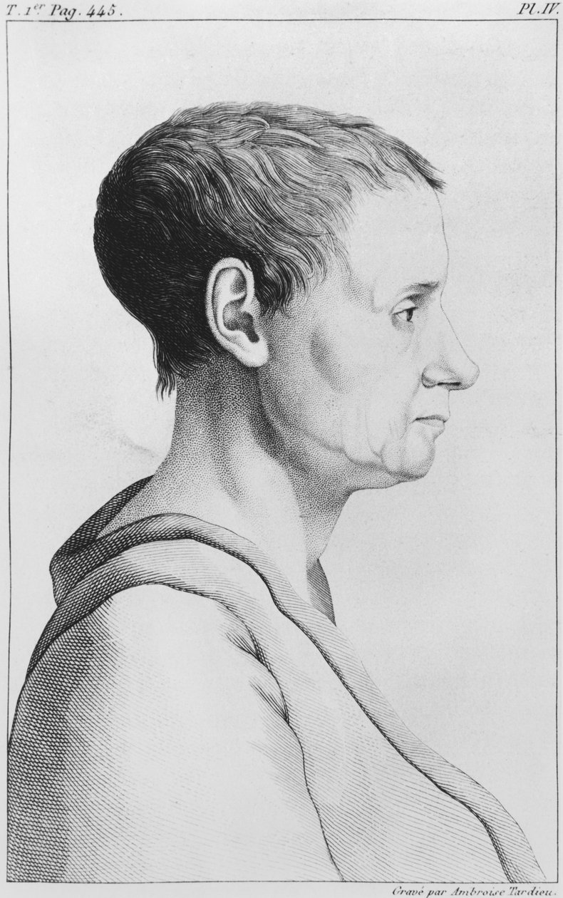 Theroigne de Mericourt, illusztráció Etienne Esquirol (1772-1840) "Des Maladies Mentales considerees sous le rapport medical, hygienique et medico-legal" című művéből, IV. tábla, 1838. alkotó: Ambroise Tardieu