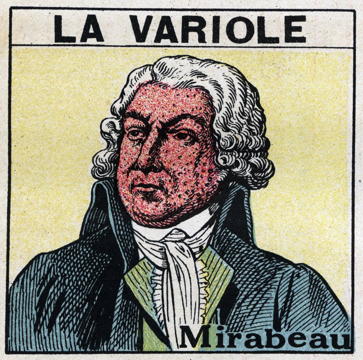 Honore Gabriel (Honore-Gabriel) Riqueti, Mirabeau grófjának (1749-1791) portréja himlős arccal. A himlő okozta hegek elkerülése érdekében a betegeket szobákban kell kezelni, vagy csak vörös, ultraibolya sugárzástól mentes fénybe kell belépni. Névtelen bete alkotó: Anonymous Anonymous