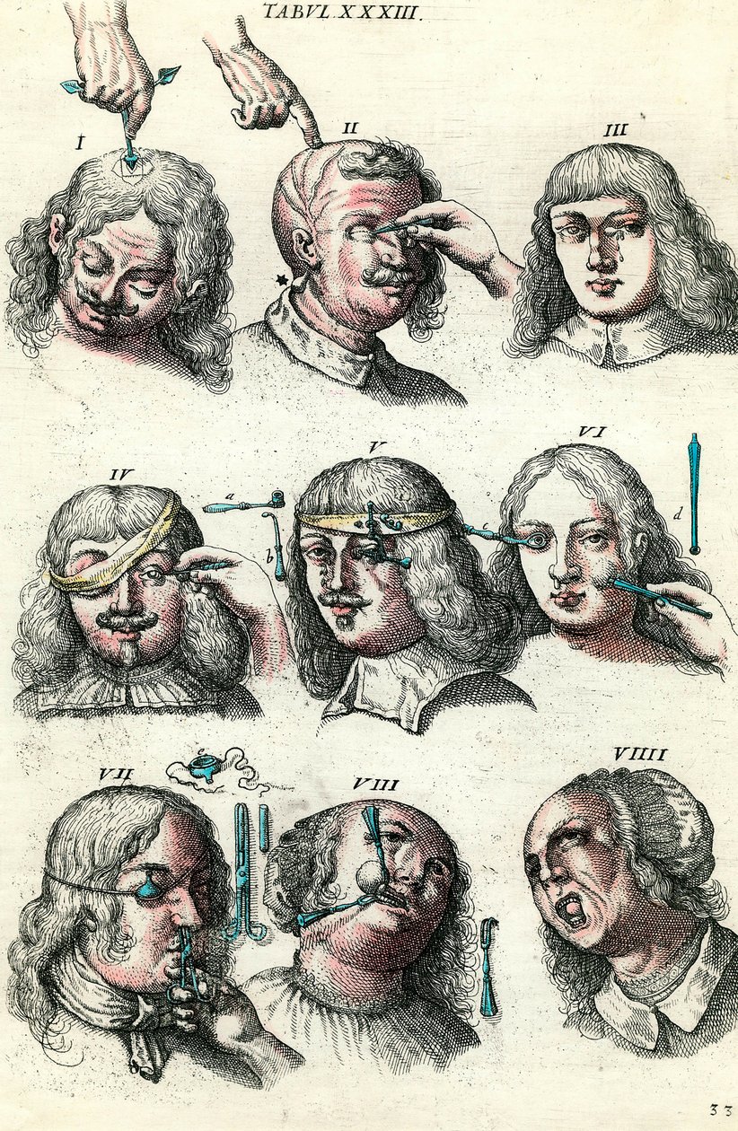 Sebészet a 18. században: A szem és az arc trepanációja, műtétje. Metszet Lorenz Heister „Institutions chirurgicale”-ba alkotó: Anonymous Anonymous