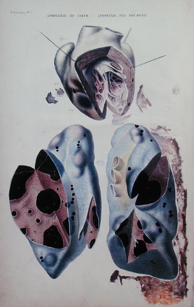 A szív és a tüdő apoplexiája, Jean Cruveilhier (1791-1874) „Anatomie pathologique du corps humain” című művének illusztrációja, Párizsban megjelent alkotó: Antoine Chazal