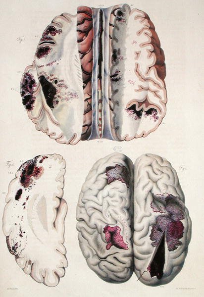 Kapilláris apoplexia, Jean Cruveilhier (1791-1874) „Anatomie Pathologique du Corps Humain” című művéből, 1828-42 (színes metszet) alkotó: Antoine Chazal