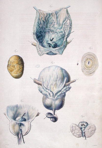 A húgyhólyag és a prosztata betegségei, Jean Cruveilhier (1791-1874) „Anatomie Pathologique du Corps Humain” című művéből, 1828-42 (színes metszet) alkotó: Antoine Chazal