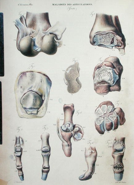 Az ízületek betegségei, Jean Cruveilhier (1791-1874) "Anatomie Pathologique du Corps Humain" című művéből, 1828-42 (színes metszet). alkotó: Antoine Chazal