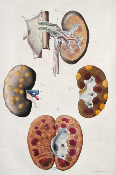 A vesék betegségei, Jean Cruveilhier (1791-1874) "Anatomie Pathologique du Corps Humain" című művéből, 1828-42 (színes metszet). alkotó: Antoine Chazal
