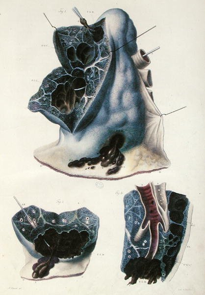 A tüdő betegségei, Jean Cruveilhier (1791-1874) "Anatomie Pathologique du Corps Humain" című művéből, 1828-42 (színes metszet). alkotó: Antoine Chazal