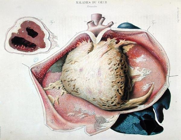 Pericarditis, Jean Cruveilhier (1791-1874) „Anatomie pathologique du corps humaine” szívbetegségeket ábrázoló lemeze, Párizsban megjelent alkotó: Antoine Chazal