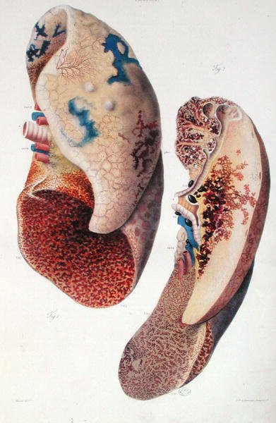 Tüdőgyulladás, Jean Cruveilhier (1791-1874) „Anatomie Pathologique du Corps Humain” című művéből, 1828-42 (színes metszet) alkotó: Antoine Chazal