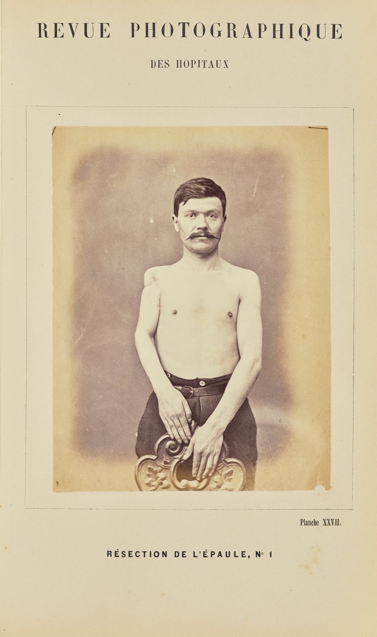 Váll reszekció, 1. szám alkotó: Arthur de Montmeja