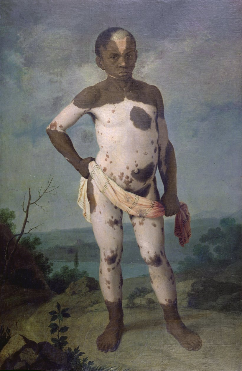 Vitiligós gyermek, 1786 alkotó: Brazilian School