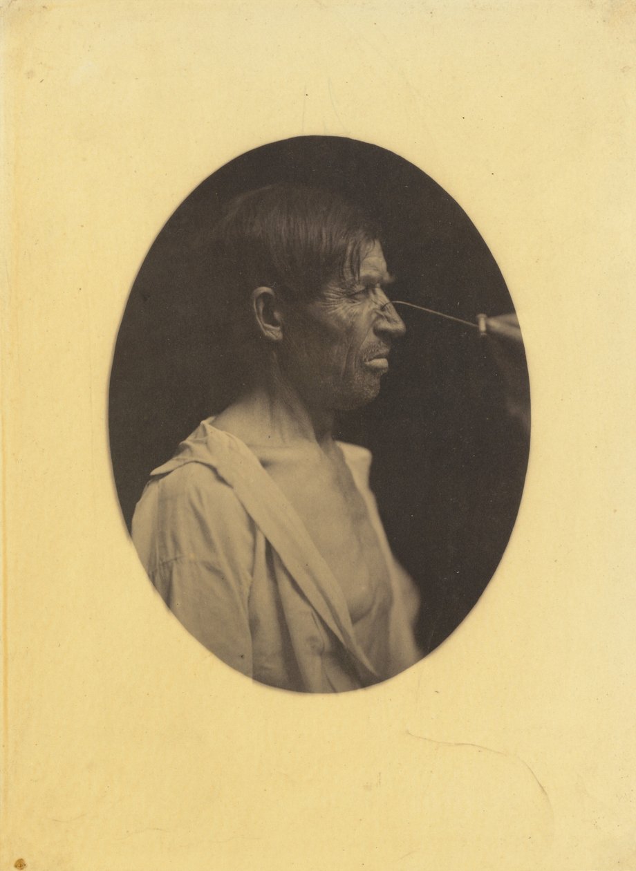 Rossz humor, elégedetlenség, 1854-1856, nyomtatva 1862. alkotó: Duchenne de Boulogne