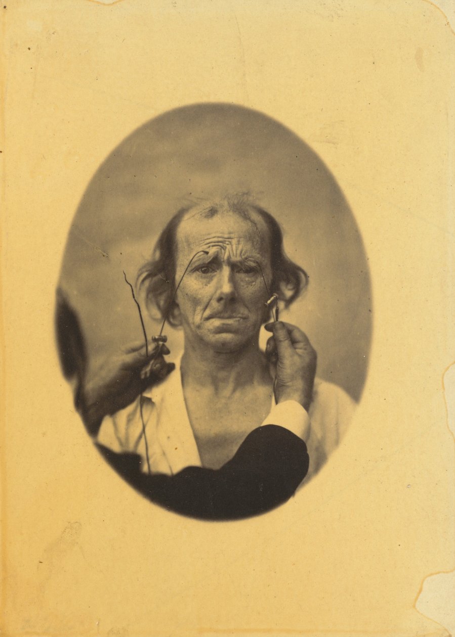 Elégedetlenség, komor gondolatok balra, Reflexió jobbra, 1854-1856, nyomtatva 1862. alkotó: Duchenne de Boulogne