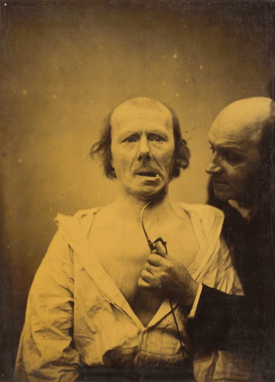 Ez az összehúzódás a m. A platysma önmagában hiányzik a kifejezésből, 1854-1856, nyomtatva 1862. alkotó: Duchenne de Boulogne