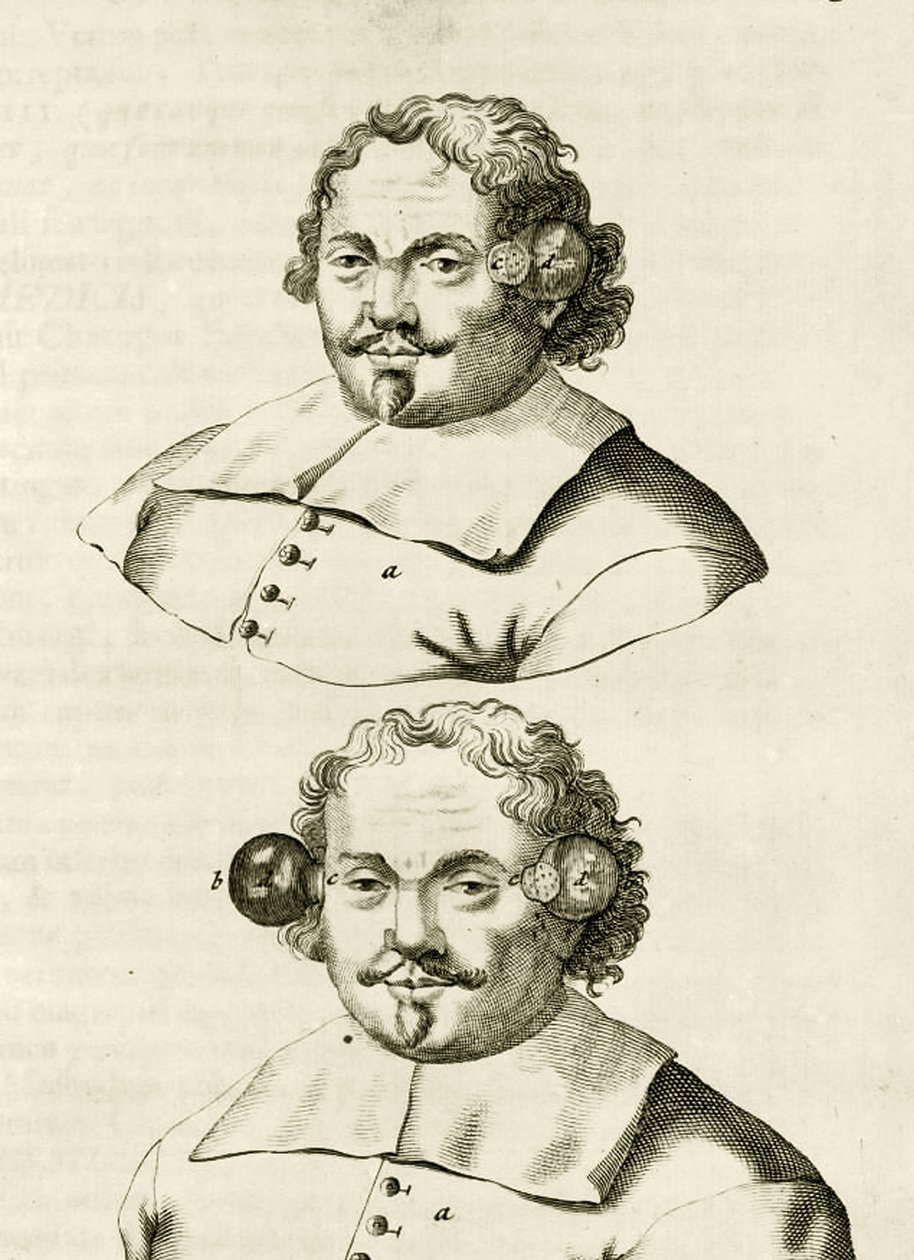 Egy példa a köpölyözésre, Frederik Dekkers The Practice of Medicine című könyvéből, 1694 alkotó: Dutch School
