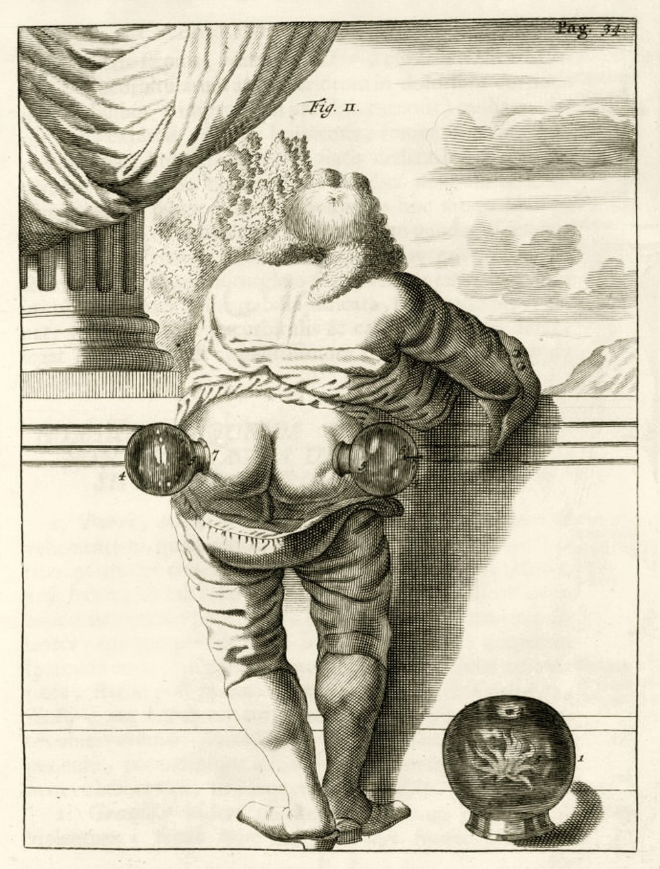 Egy példa a köpölyözésre, Frederik Dekkers The Practice of Medicine című könyvéből, 1694 alkotó: Dutch School
