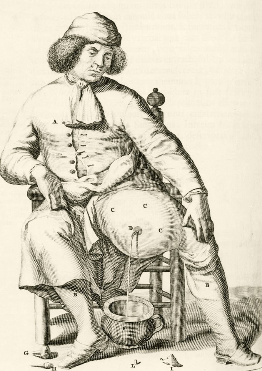 Folyadék leeresztése tályogból Frederik Dekkers, 1694 alkotó: Dutch School