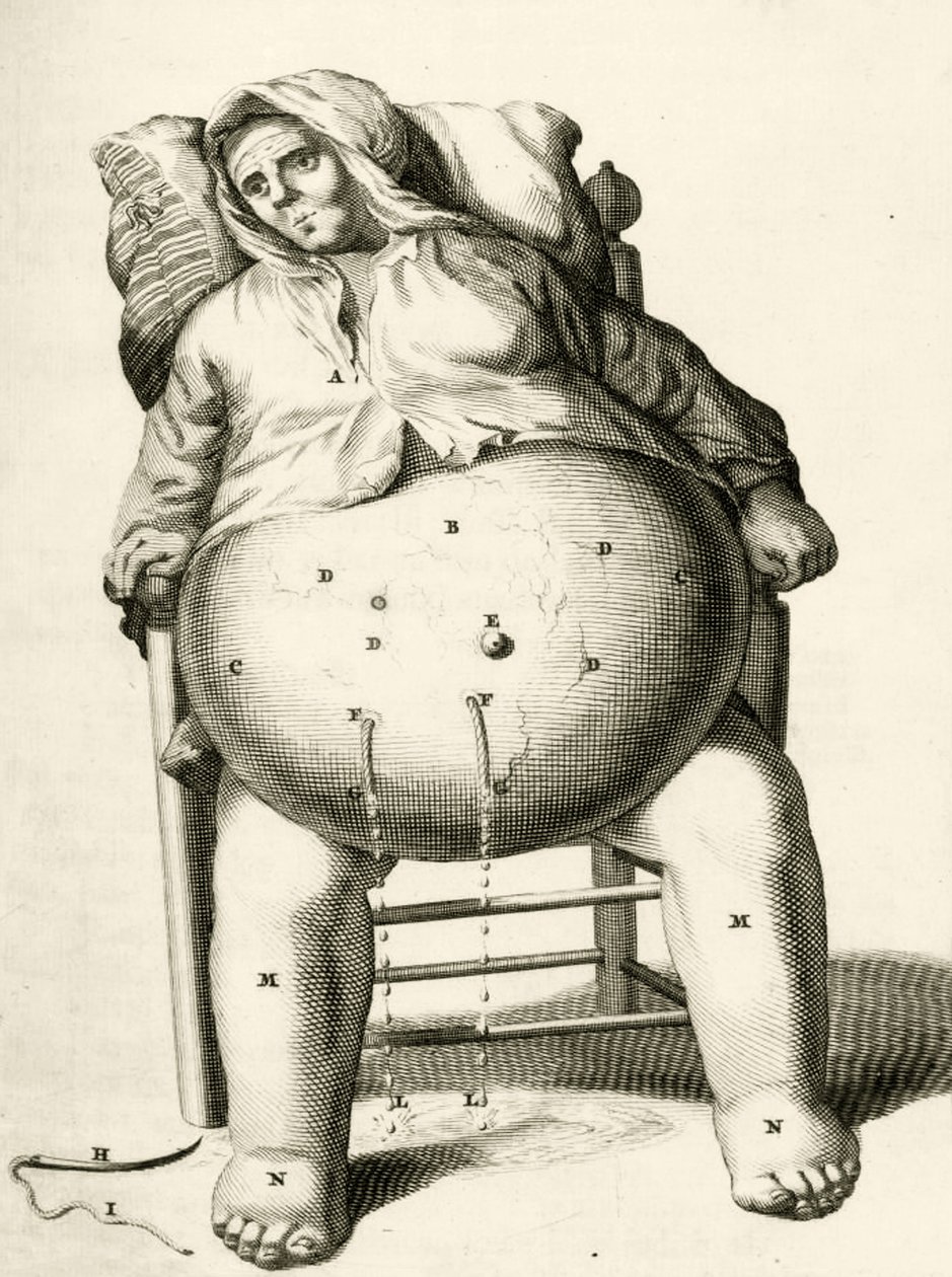 Folyadékleeresztés egy tályogból Frederik Dekkers, 1694 alkotó: Dutch School