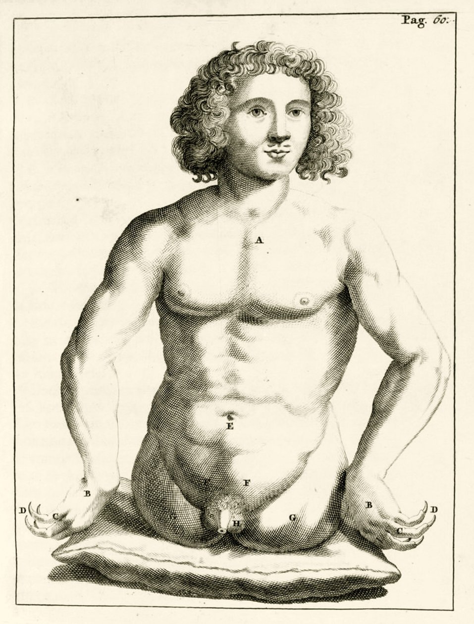 Példa veleszületett rendellenességekre Frederik Dekkers, 1694 alkotó: Dutch School