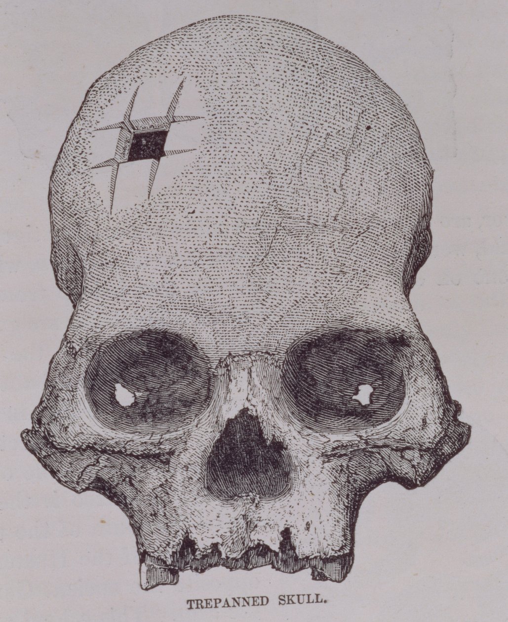 Trepanned Skull, E. George Squier „Incidents of Travel and Exploration in the Land of the Inka”, pub. 1878-ban alkotó: English School