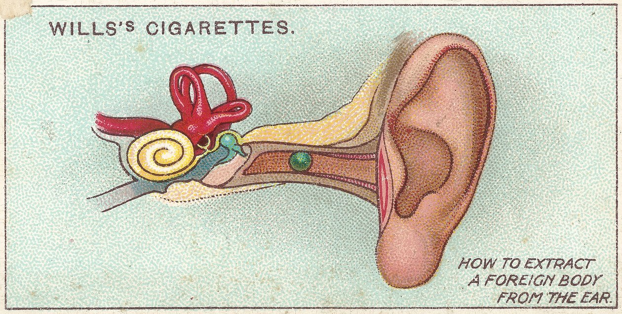 Idegen test a fülben, sz. 30 a Willss cigarettakártyák First Aid sorozatából, 1913 alkotó: English School
