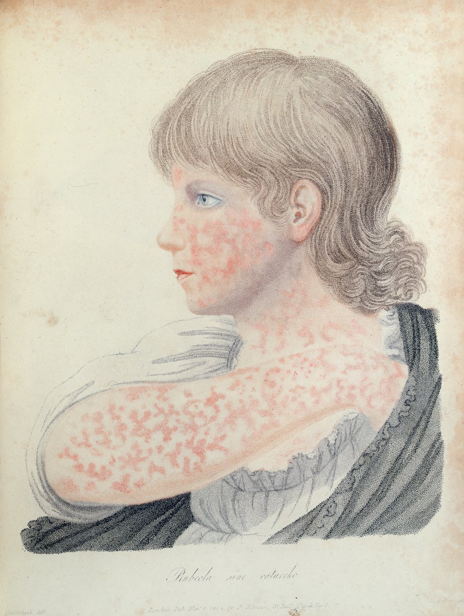 Német kanyaró, illusztráció Robert Willan (1757-1812) könyvéhez, 1808 (színes metszet) alkotó: English School