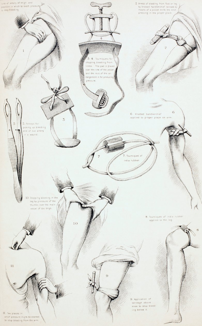 A vérzés megállításának módszerei, 1890 körül alkotó: English School