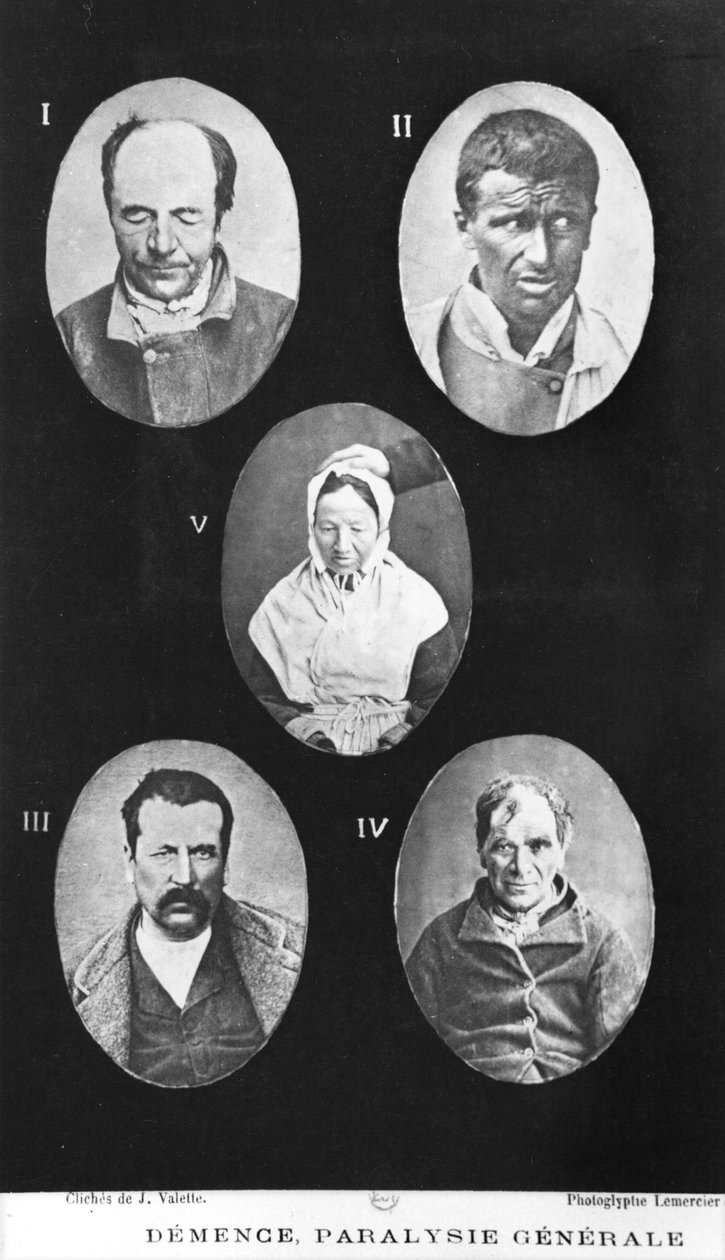 Demencia, általános bénulás, illusztráció Henri Dagonet (1823-1902) mentális betegségekről szóló új elemi és gyakorlati értekezéséből, Paris, Bailliere, 1876 alkotó: French Photographer