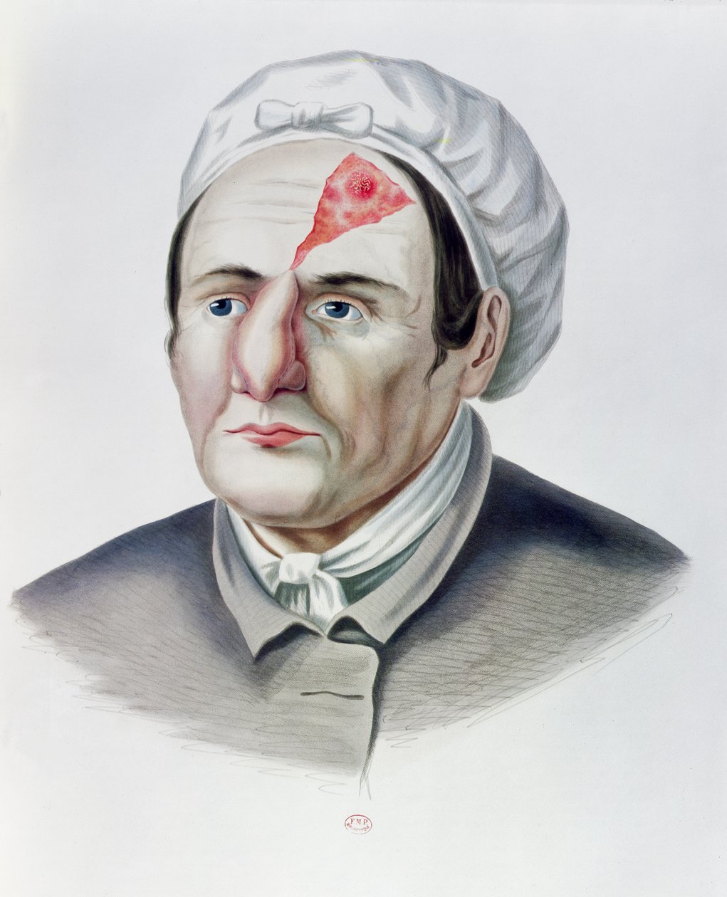 Bőrátültetés után, Alexander Auvert Selecta Praxis Medico-Chirurgica cégétől, Párizs, 1856 alkotó: French School
