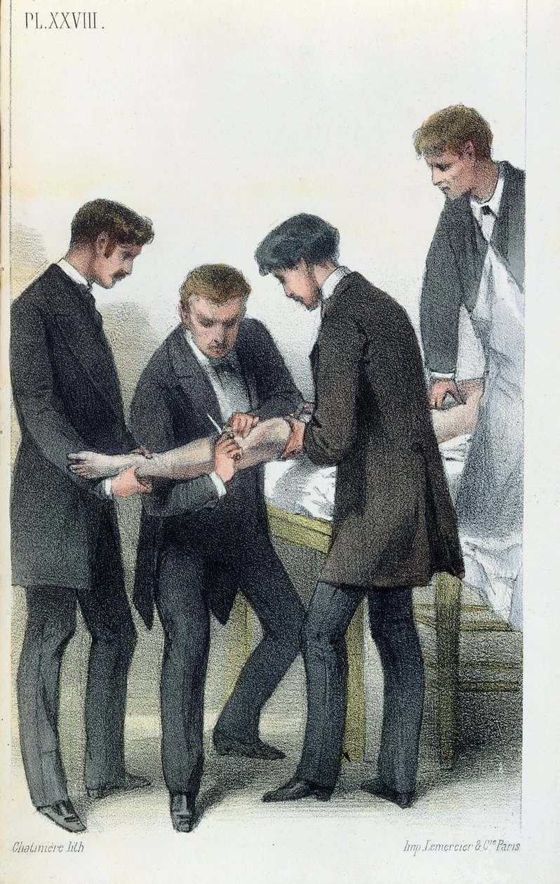 Egy kar amputálása, Jean-Baptiste-Leon Dubreuil orvosi kézikönyvéből, 1850-60 körül alkotó: French School
