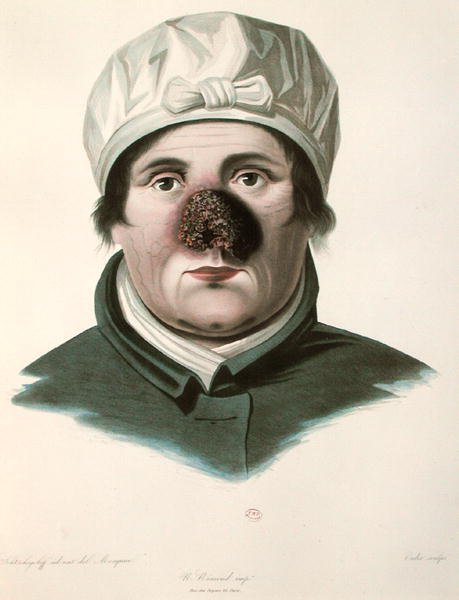 Bőrátültetés előtt, Alexander Auvert „Selecta Praxis Medico-Chirurgica”-tól, Párizs alkotó: French School
