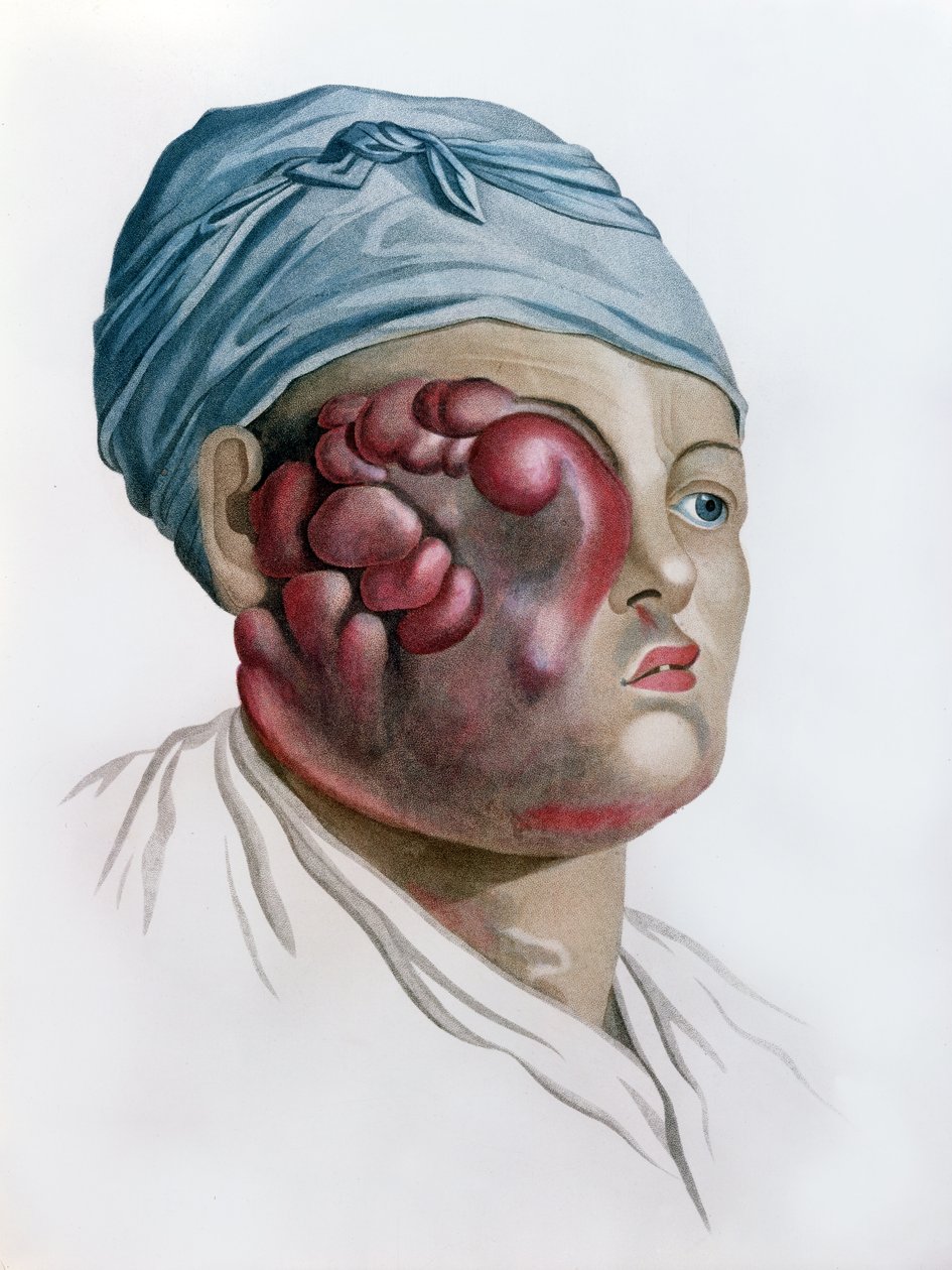 Rákos scrofula, Jean Louis Alibert báró (1768-1837) Leírás des Maladies de la Peau című művéből, Párizs, 1806 alkotó: French School