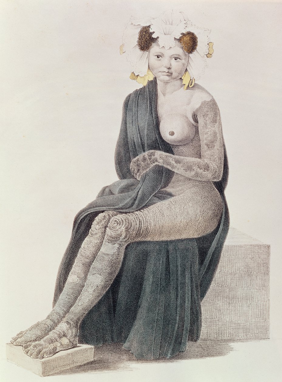 Congenitalis Ichthyosis, G.M. könyvéből. Olbers, 1830 alkotó: French School