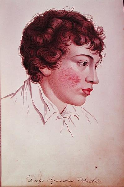 Száraz tapasz, Jean Louis Alibert (1768-1837) báró „Description des Maladies de la Peau” című művéből alkotó: French School