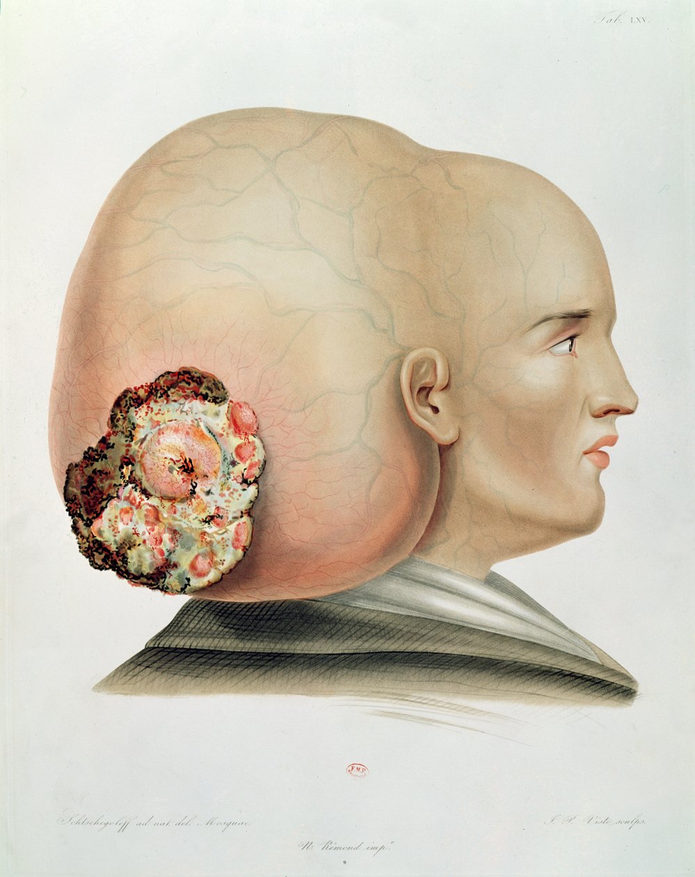 A dura mater gomba, Alexander Auvert Selecta Praxis Medico-Chirurgica termékéből, Párizs, 1856 alkotó: French School