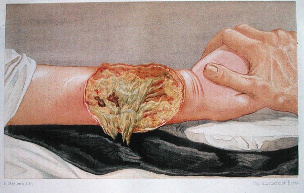 Kórházi gangréna, Edmund Delorme (1847-1929) "Traite de Chirurgie de Guerre" című művéből, metszette F. Meheux. alkotó: French School