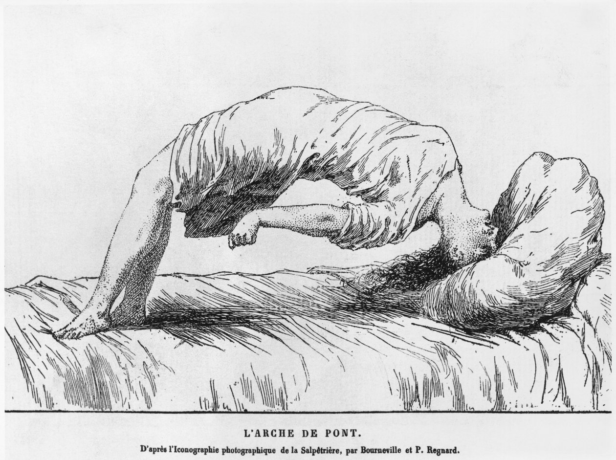 Hisztéria és somnambulizmus, Paul Regnard (1850-1927) Les Maladies Epidemiques de lEsprit című művéből, 1884 alkotó: French School