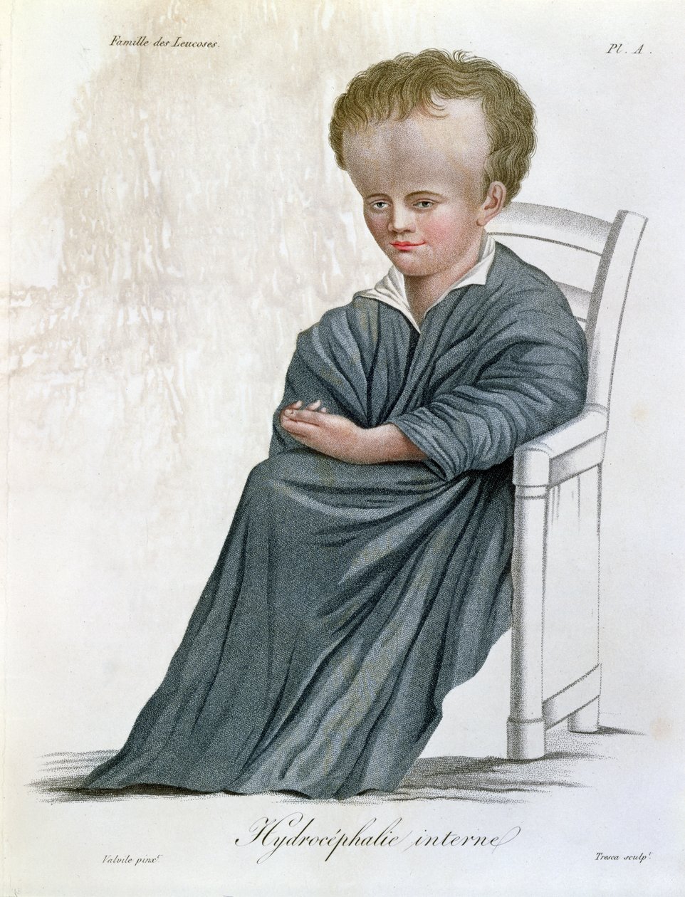 Belső Hydrocephalus, a Nosologie Naturelle-ből, Jean Louis Alibert báró (1768-1837) vésette Tresca, 1817 alkotó: French School