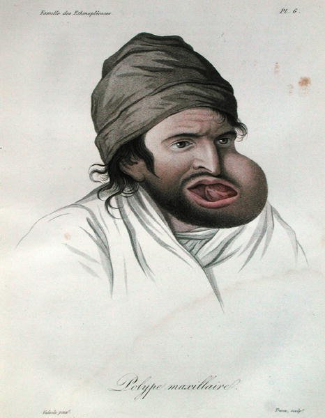 Maxilláris polip, báró Jean Louis Alibert (1768-1837) könyvéből, 1817 (színes metszet) alkotó: French School