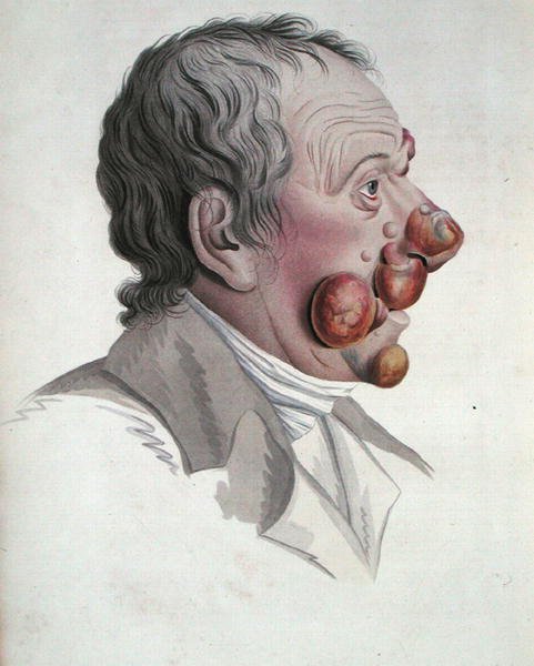Mycosis Fongoide, Jean Louis Alibert báró (1768-1837) könyvéből 1838 (színes metszet) alkotó: French School