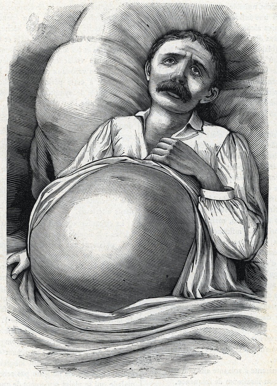 Előrehaladott májcirrhosisban szenvedő beteg (metszet) 1888 alkotó: French School