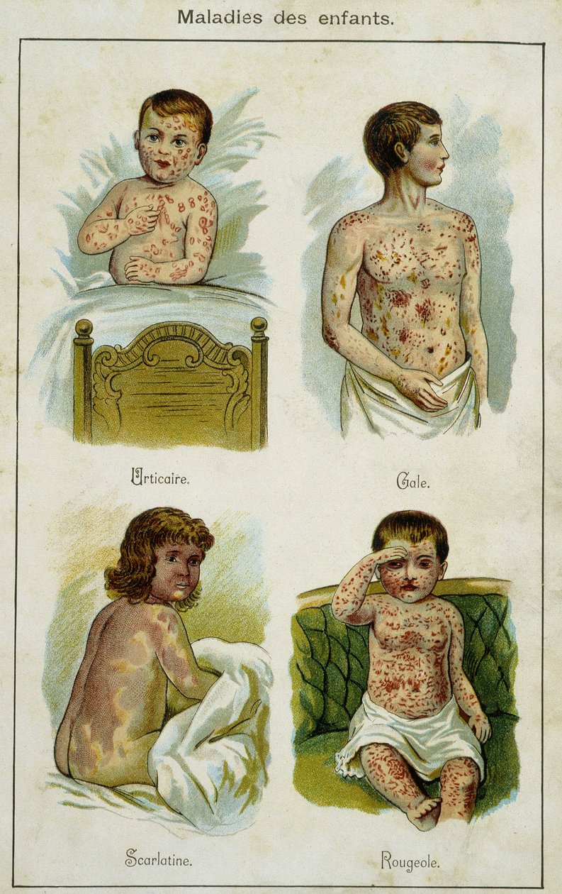 Gyermekbetegségeket ábrázoló tábla: csalánkiütés, rüh, skarlát és kanyaró (bilzi rák, természetes gyógyszer) 19. század vége. alkotó: French School