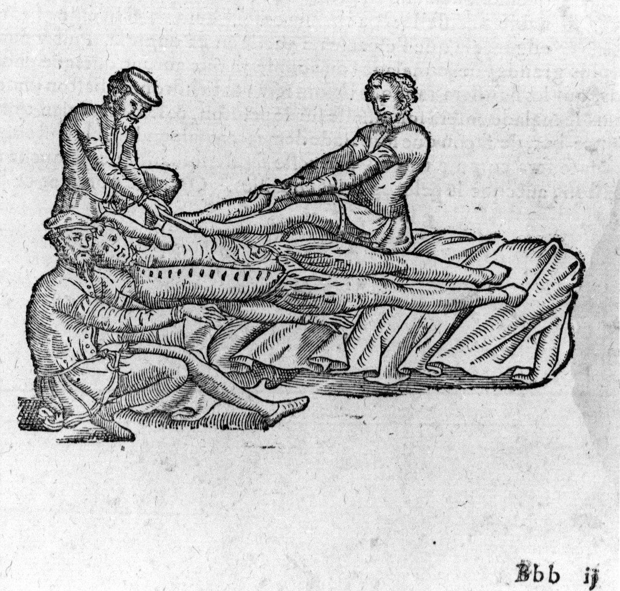 Diszlokáció csökkentése, „Ambroise Paré orvosi értekezésében”, 1560 körül. alkotó: French School
