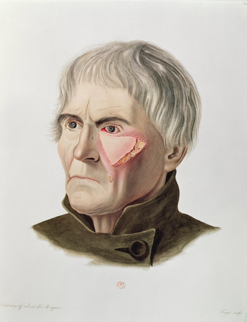 Bőrátültetés műtét, a Selecta Praxis Medico-Chirurgica cégtől, Alexander Auvert, Párizs, 1856 alkotó: French School