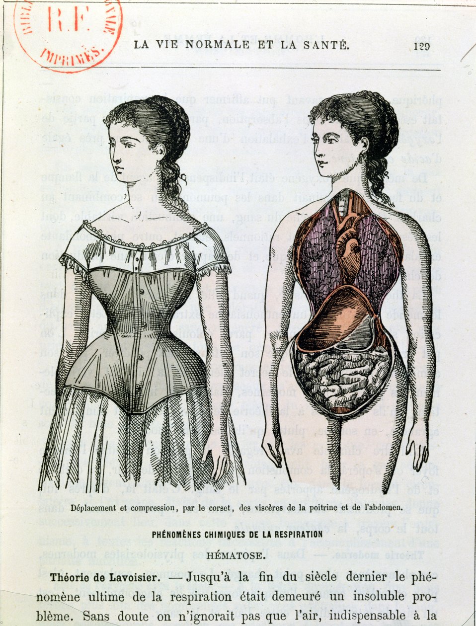 A fűző káros hatásai, Dr. Jules Rengade (sz. 1841) illusztrációja a La Vie Normale et la Sante-ból, 1880 körül alkotó: French School