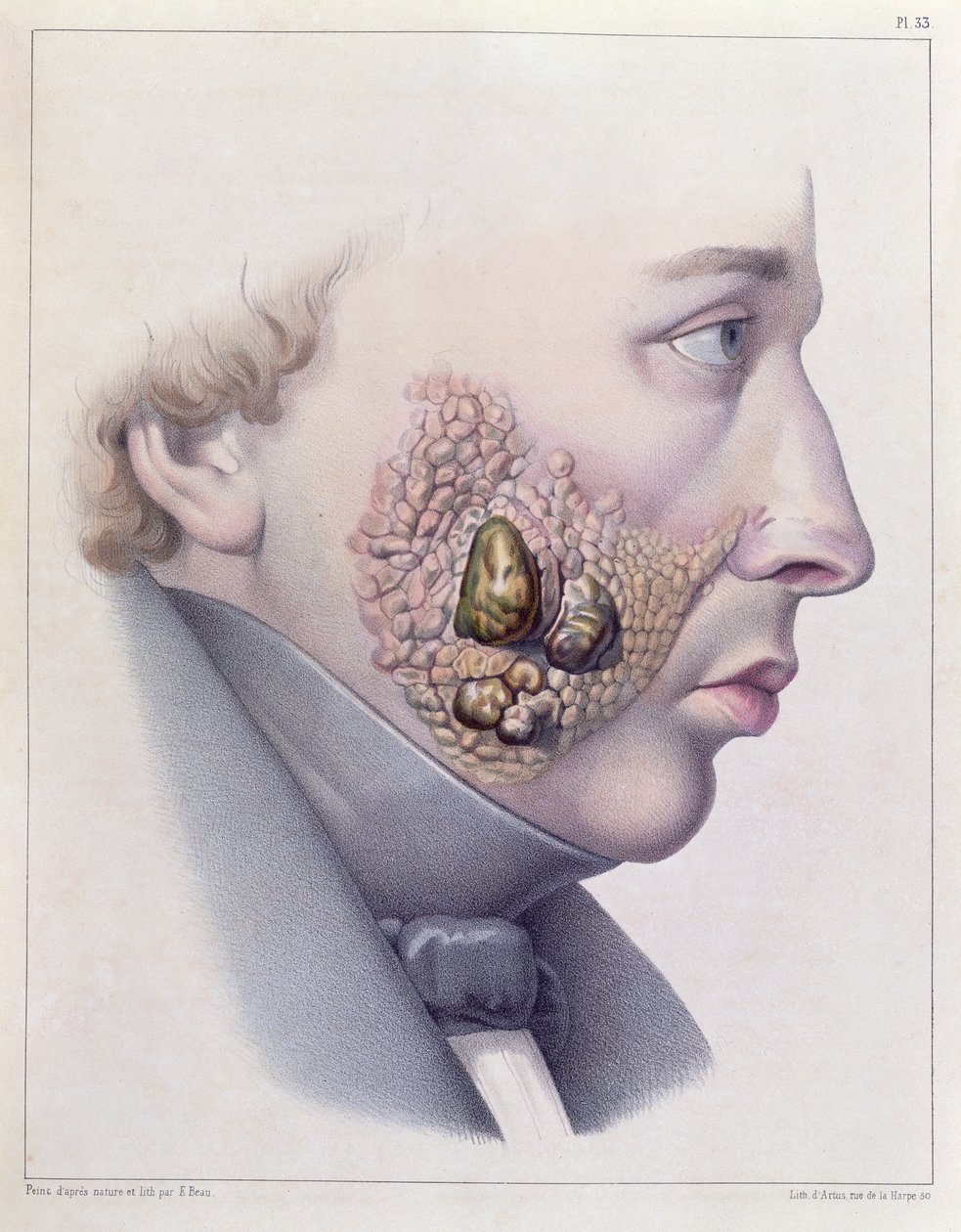 A nemi betegségek arctünetei, Philippe Ricord (1800-89) 1851-es Traite Complet des Maladies Veneriennes-ből alkotó: French School