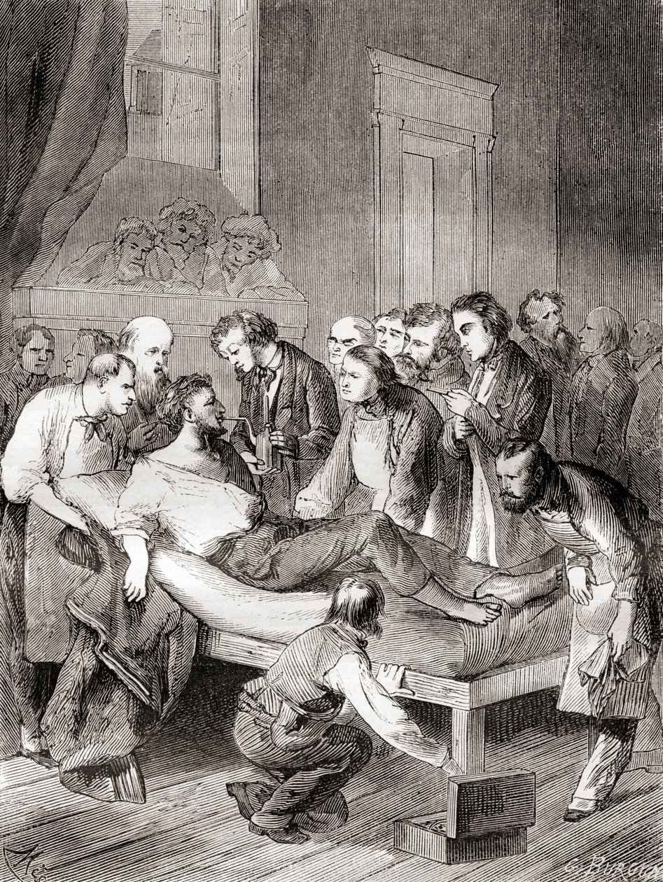 1846-ban egy amerikai fogorvos, William Thomas Green Morton először nyilvánosan bemutatta az inhalált étert sebészeti érzéstelenítőként a „Les Merveilles de la Science”-ből, 1870 körül. alkotó: French School