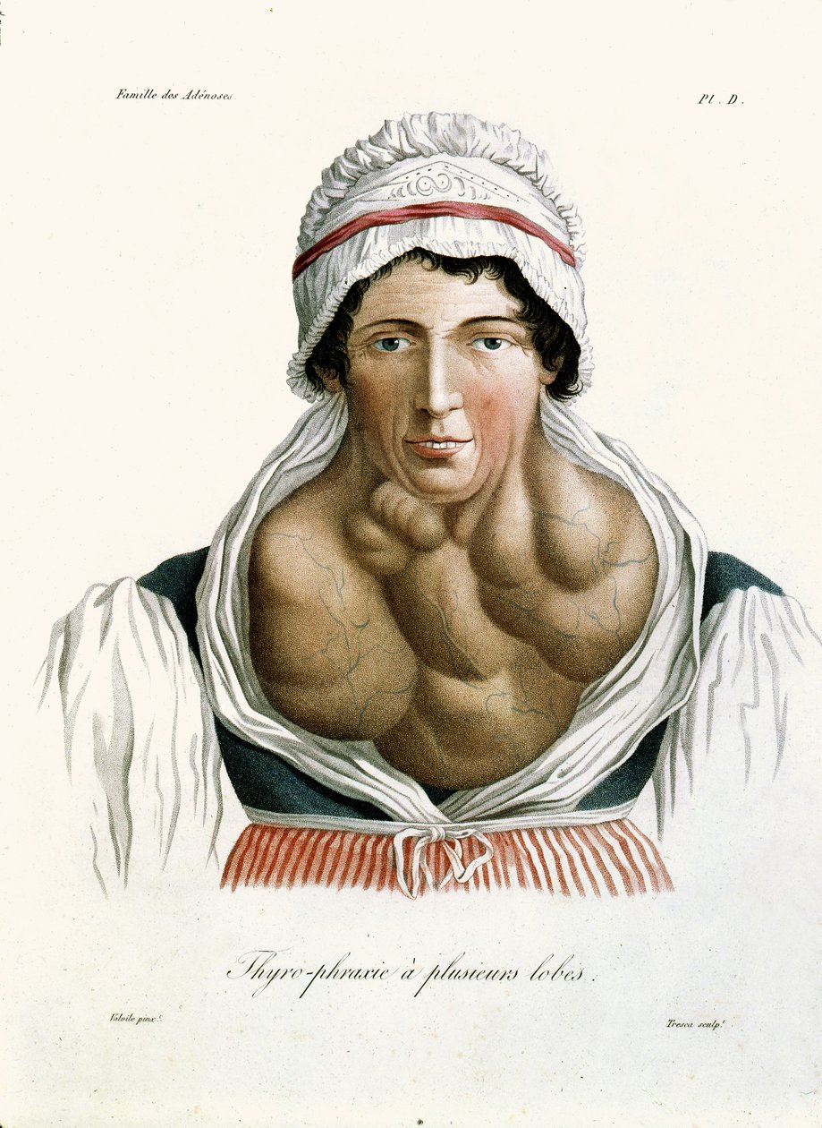 Pajzsmirigybetegség, Jean Louis Alibert báró (1768-1837) könyvéből, 1817 alkotó: French School