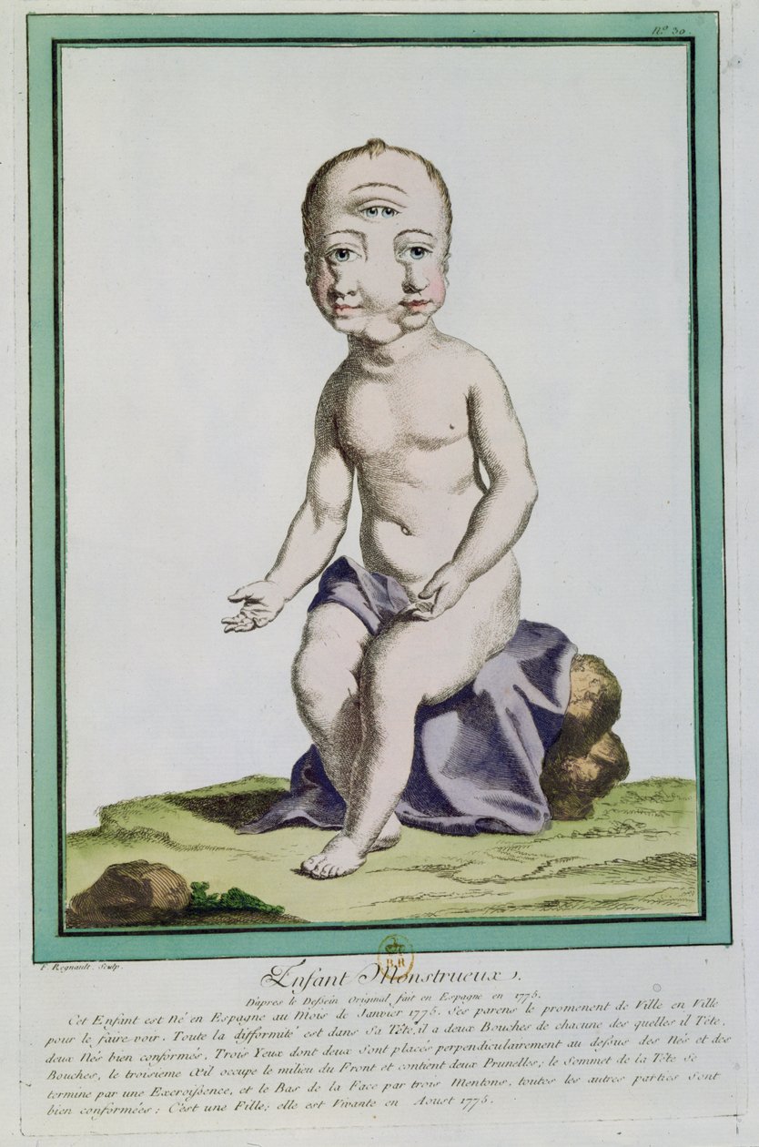 Gyermek deformált fejjel, a Les Ecarts de la Nature-ből, Párizs, 1775 alkotó: Genevieve Regnault de Nangis