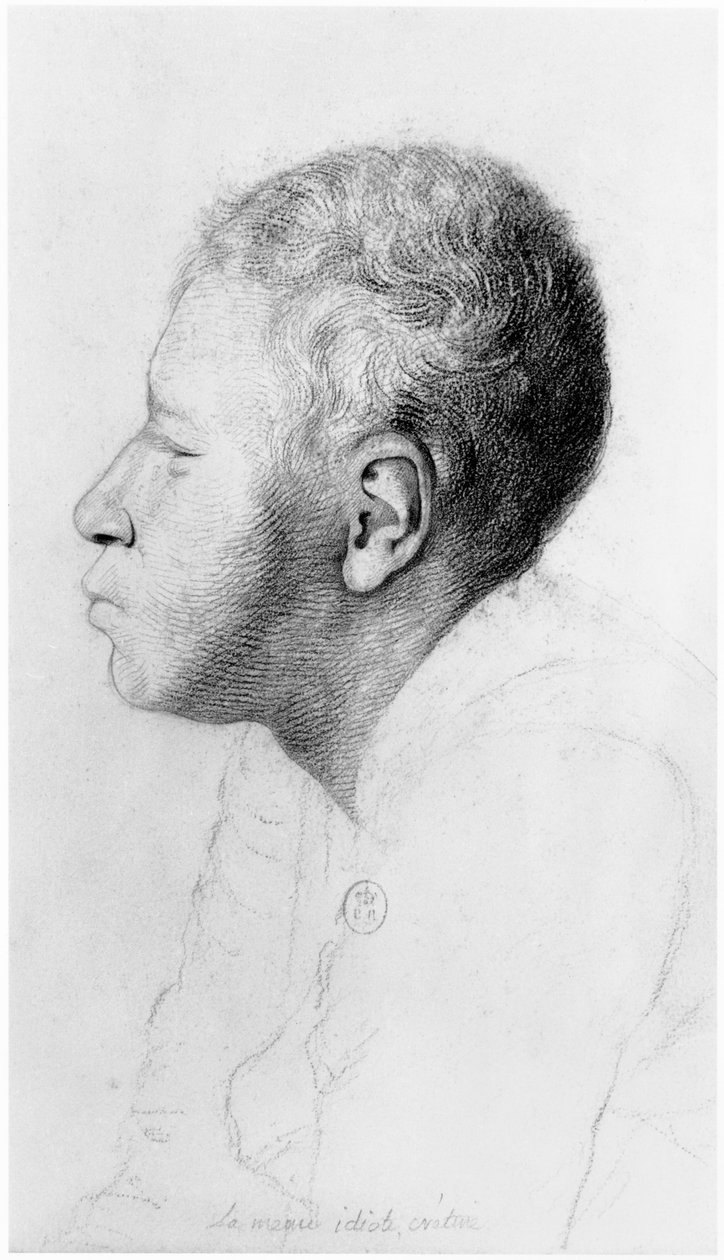 Kretén, profil, illusztráció Jean Etienne Dominique Esquirol (1772-1840) kiadatlan értekezéséből a Salpetriere menedékház őrültjeiről, 1818 körül alkotó: Georges Francois Gabriel