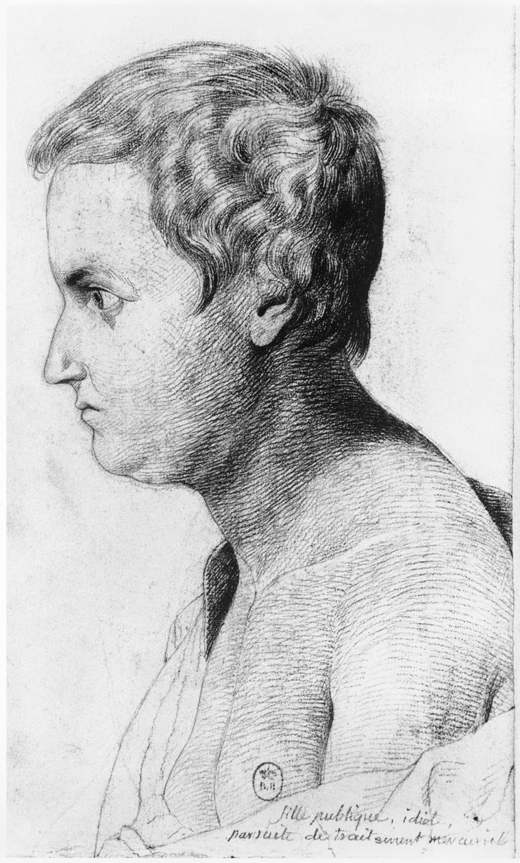 Idióta, szifiliszben szenvedő prostituált, illusztráció Jean Etienne Dominique Esquirol (1772-1840) kiadatlan értekezéséből a Salpetriere menedékház őrültjeiről, 1818 körül alkotó: Georges Francois Gabriel